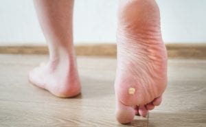 3 Questions Answered About Plantar Warts