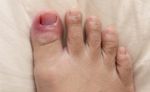 What You Should Know About Ingrown Toenails